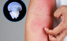 picadura de medusa brazo rojo con la piel ardor aguaviva qué hacer pis