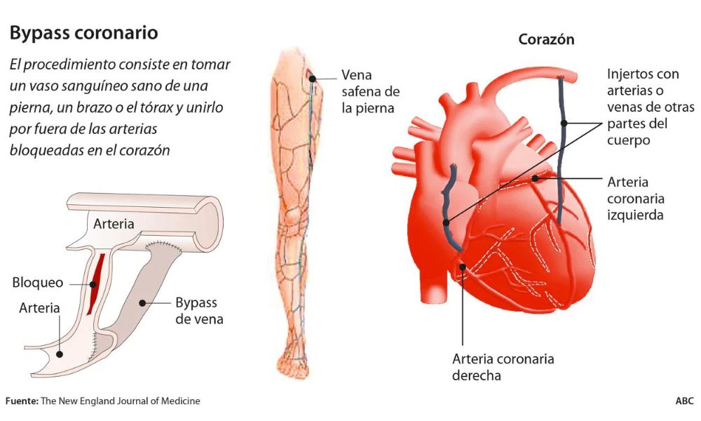 Técnica de bypass coronario - René Favaloro