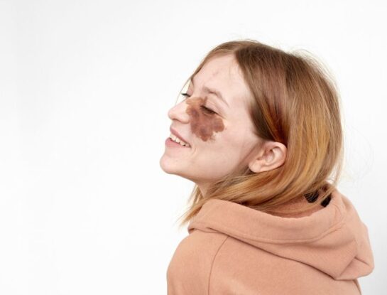 ¿Qué son las manchas de nacimiento y por qué se forman?