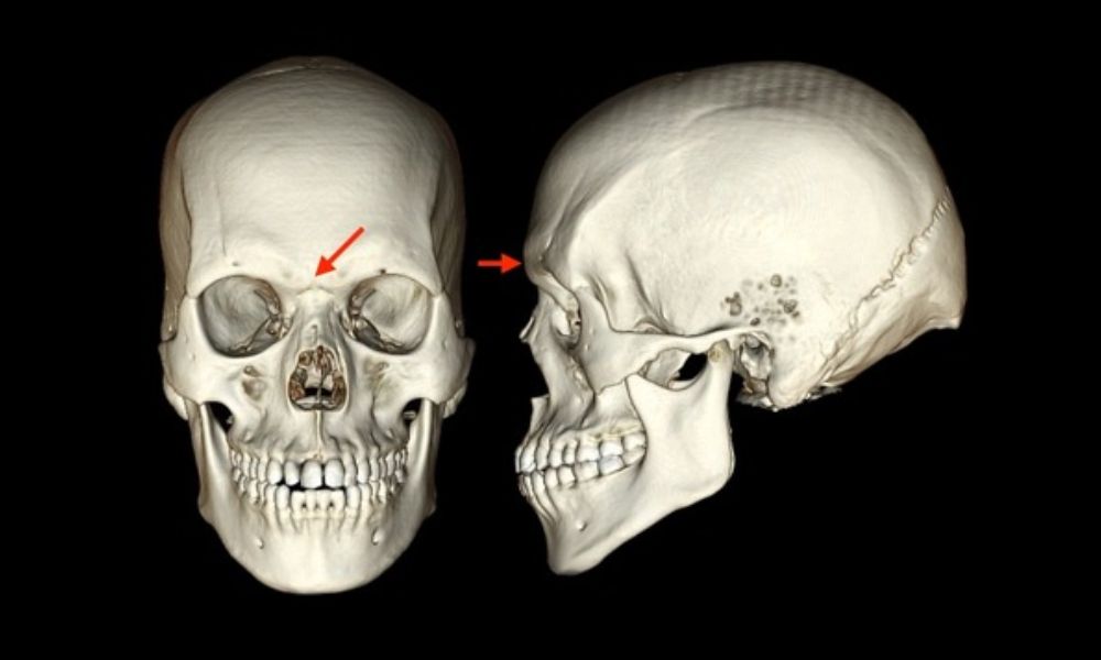 cráneo con flechas señalando la glabela