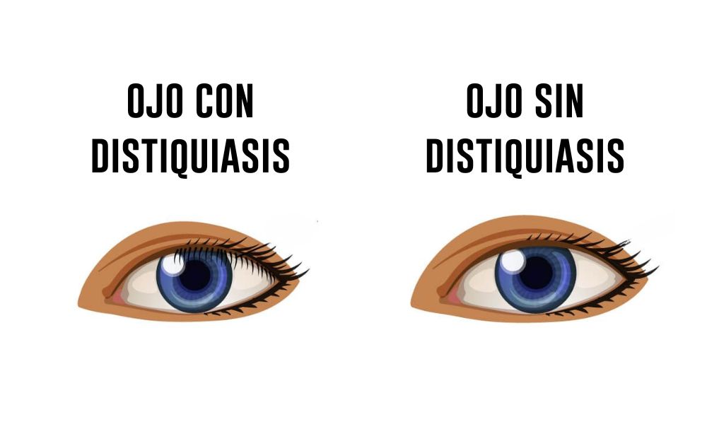 ojo con distiquiasis infografía en español doble fila de pestañas