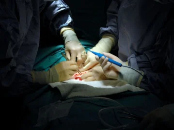 Primera cesárea exitosa